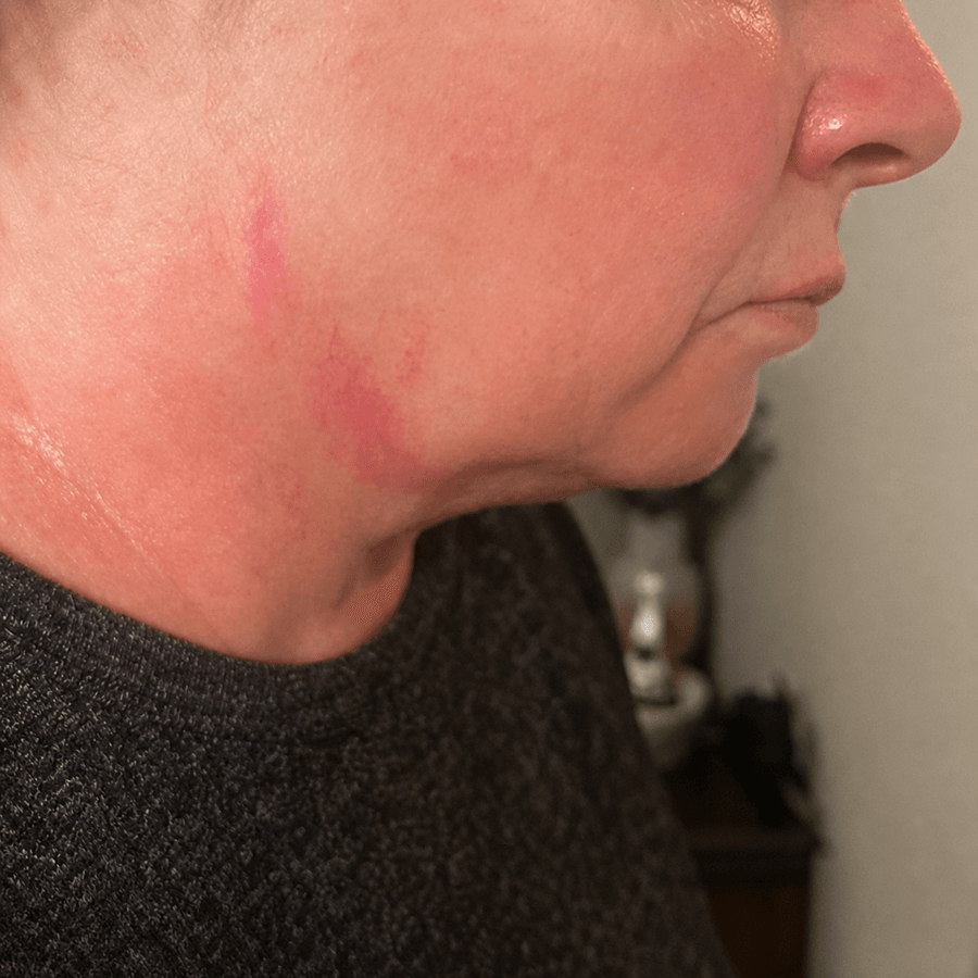 Direkt efter behandling — behandlingsresultat